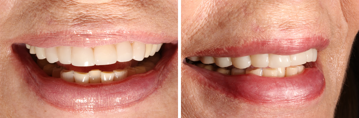 Smile Rejuvenation using Minimally Invasive Approach - After