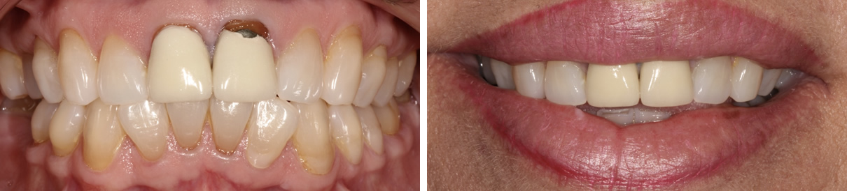 Renewing a Smile with Two New Porcelain Crowns - Before