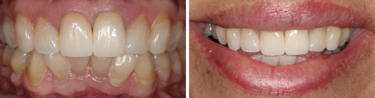 Renewing a Smile with Two New Porcelain Crowns - After
