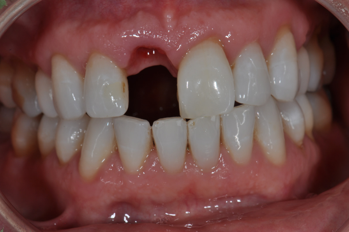 Dental Implant #2 - Before