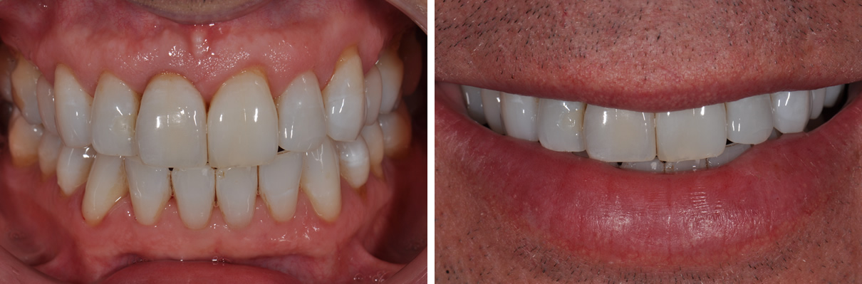 Dental Implant #2 - After