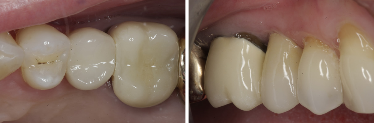 Dental Implant #1 - After