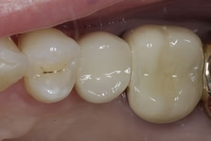 Dental Implant #1- Charlotte, NC