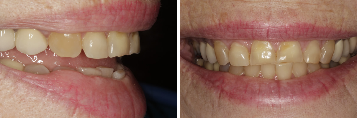 Smile Rejuvenation with Crowns and Veneers - Before