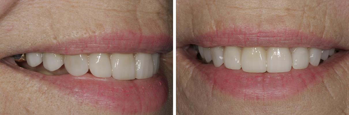 Smile Rejuvenation with Crowns and Veneers - After