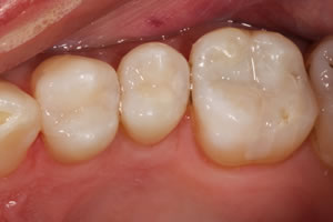 Posterior Crowns and Fillings - Charlotte, NC
