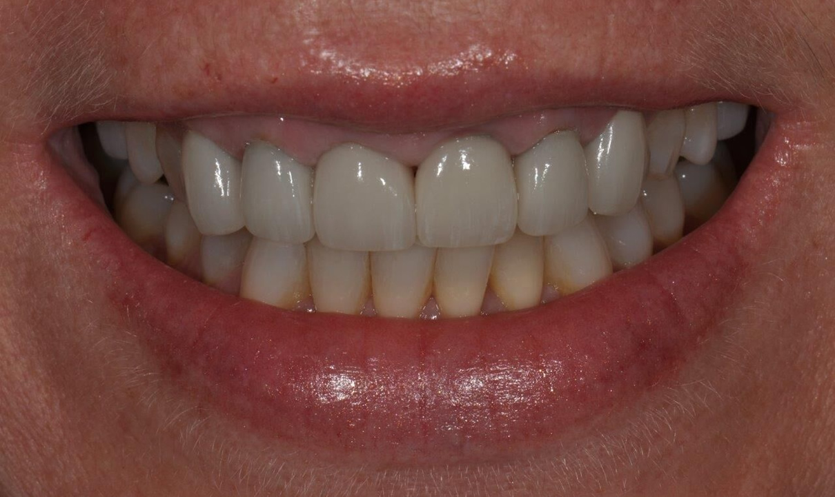 Replacement of Existing Dentistry - Before