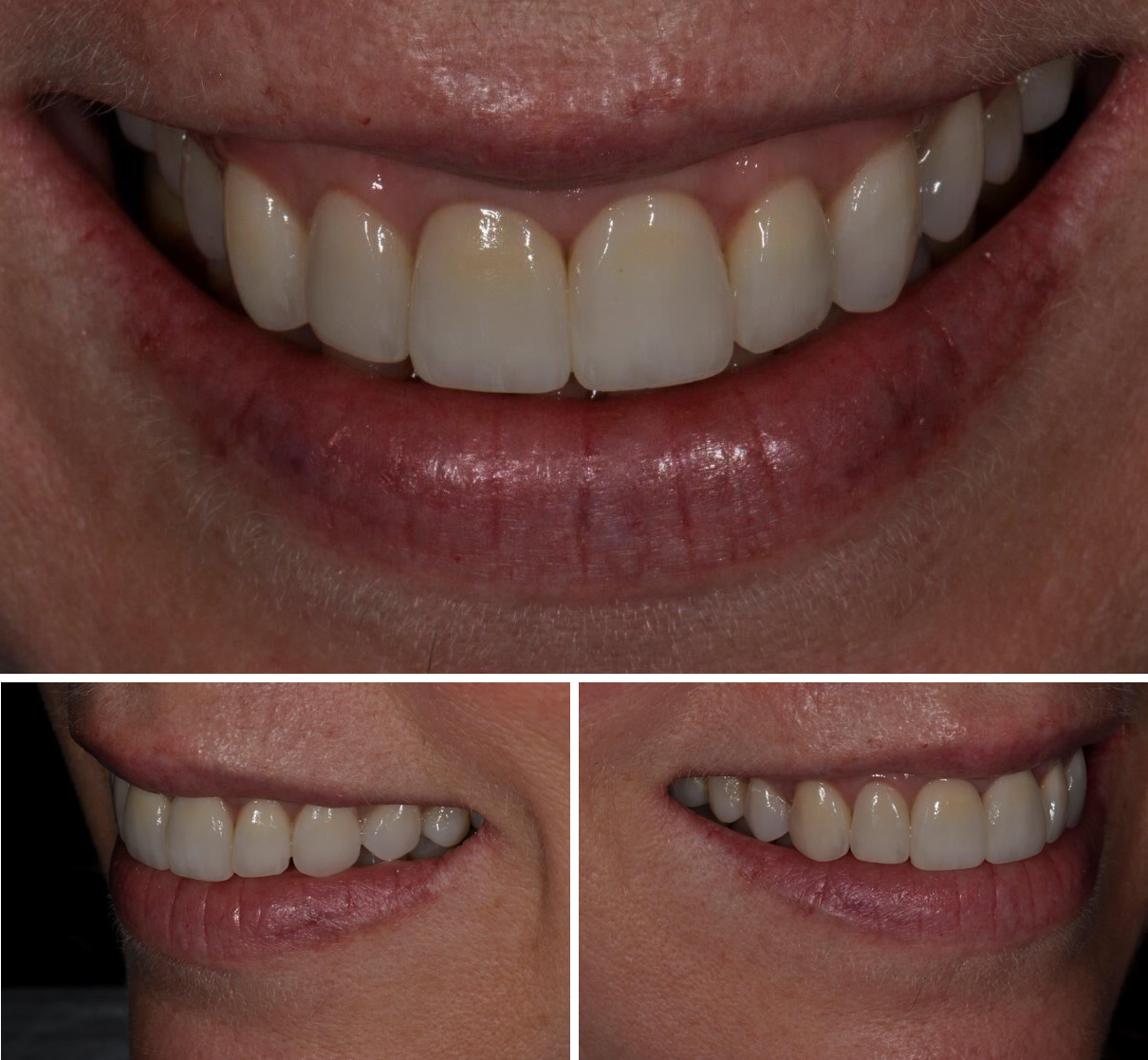 Replacement of Existing Dentistry - After