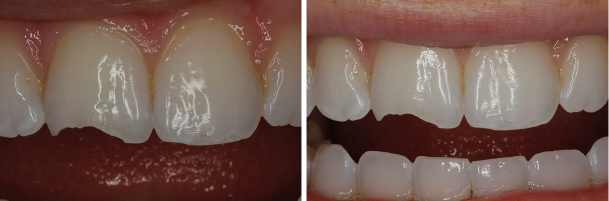 Trauma to Front Tooth - Before