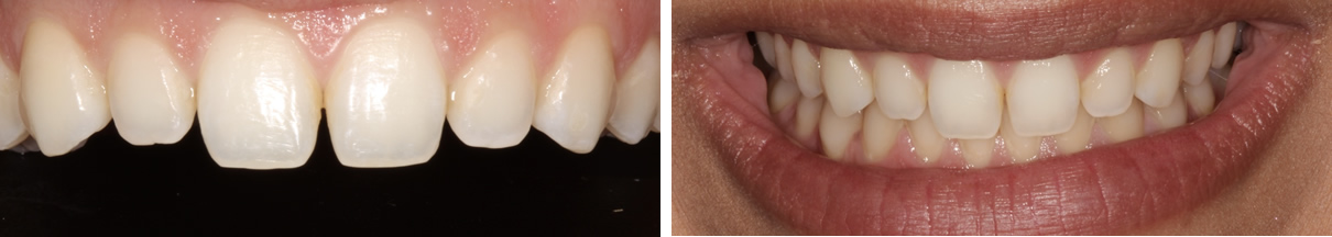 Smile Rejuvenation with Direct Bonding - Before