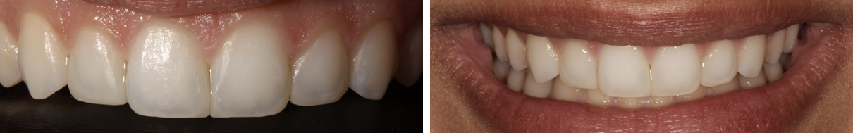 Smile Rejuvenation with Direct Bonding - After