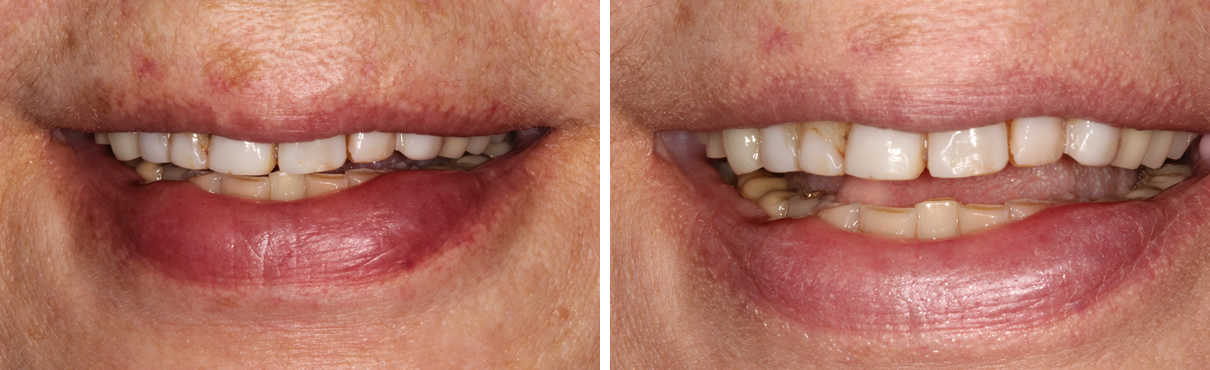 Smile Rejuvenation using Minimally Invasive Approach - Before