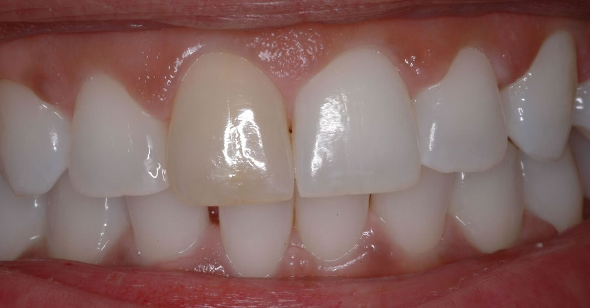 Composite Bonding (Case #3) - Before