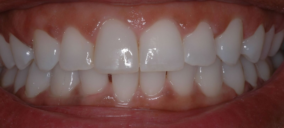 Composite Bonding (Case #3) - After