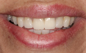 Minimally Invasive Esthetic Improvement #2 - Charlotte, NC