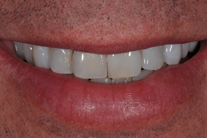 Dental Implant #2- Charlotte, NC