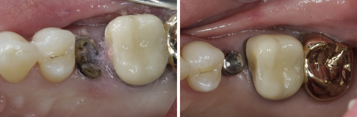 Dental Implant #1 - Before