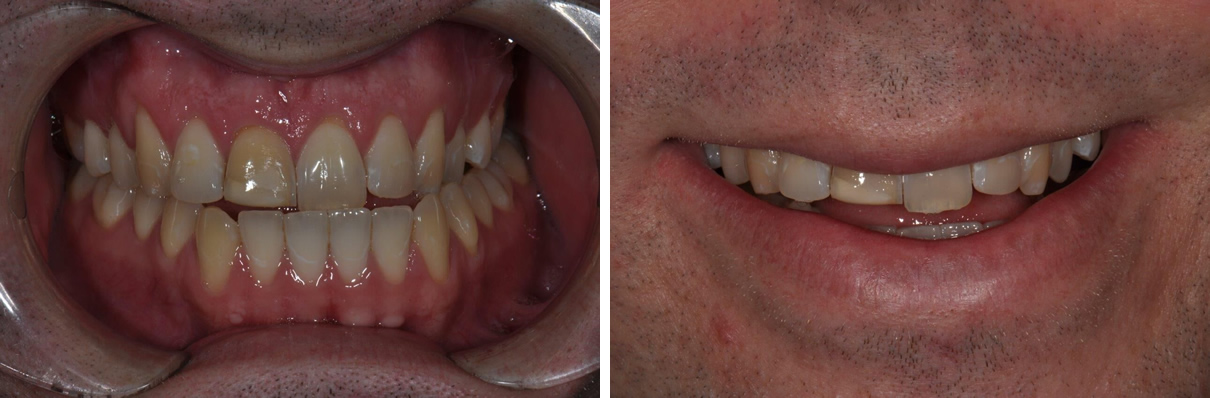 Minimally Invasive Esthetic Improvement - Before