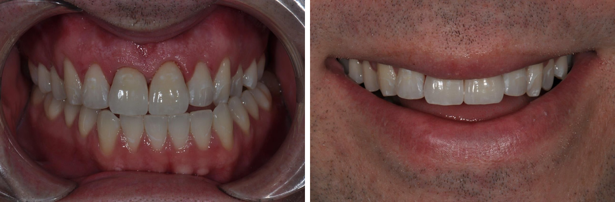 Minimally Invasive Esthetic Improvement - After