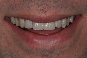 Minimally Invasive Esthetic Improvement - Charlotte, NC