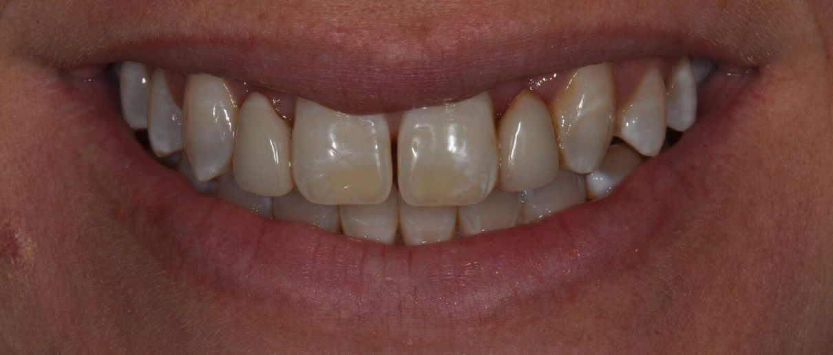 Missing Teeth Replacement - Before