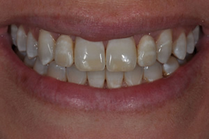 Minimally Invasive Esthetic Improvement #3 - Charlotte, NC