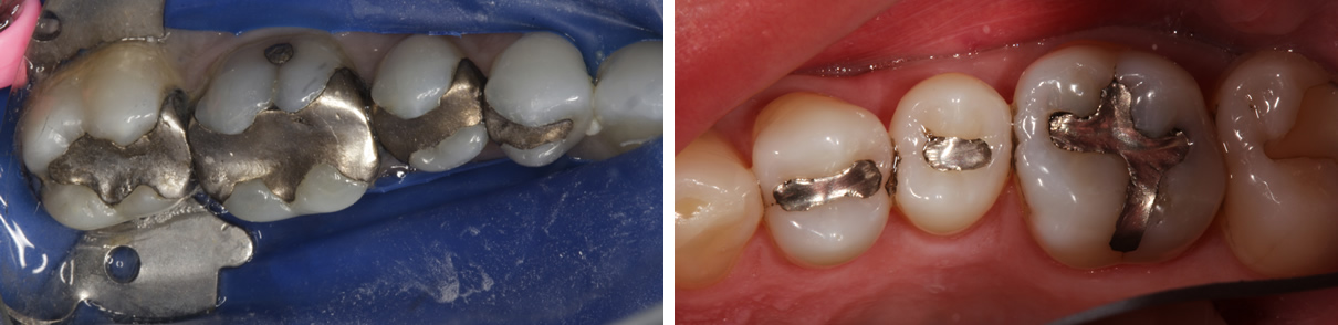 Replacing Failing Amalgam Fillings - Before