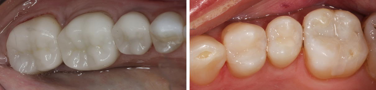 Replacing Failing Amalgam Fillings - After