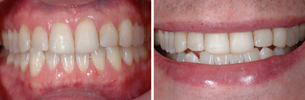 Smile Enhancement Case #1 - Before