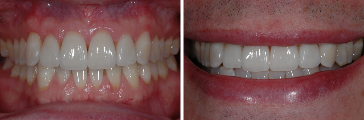 Smile Enhancement Case #1 - After