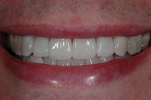 Smile Enhancement Case #1 - Charlotte, NC