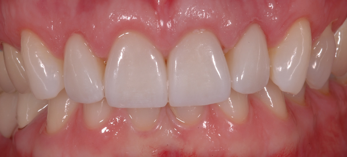 Smile Enhancement Case #2 - After