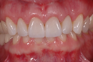 Smile Enhancement Case #2 - Charlotte, NC