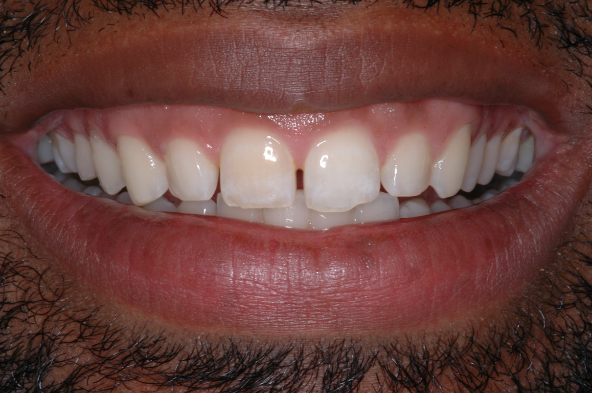 Veneers Case #1 - Before