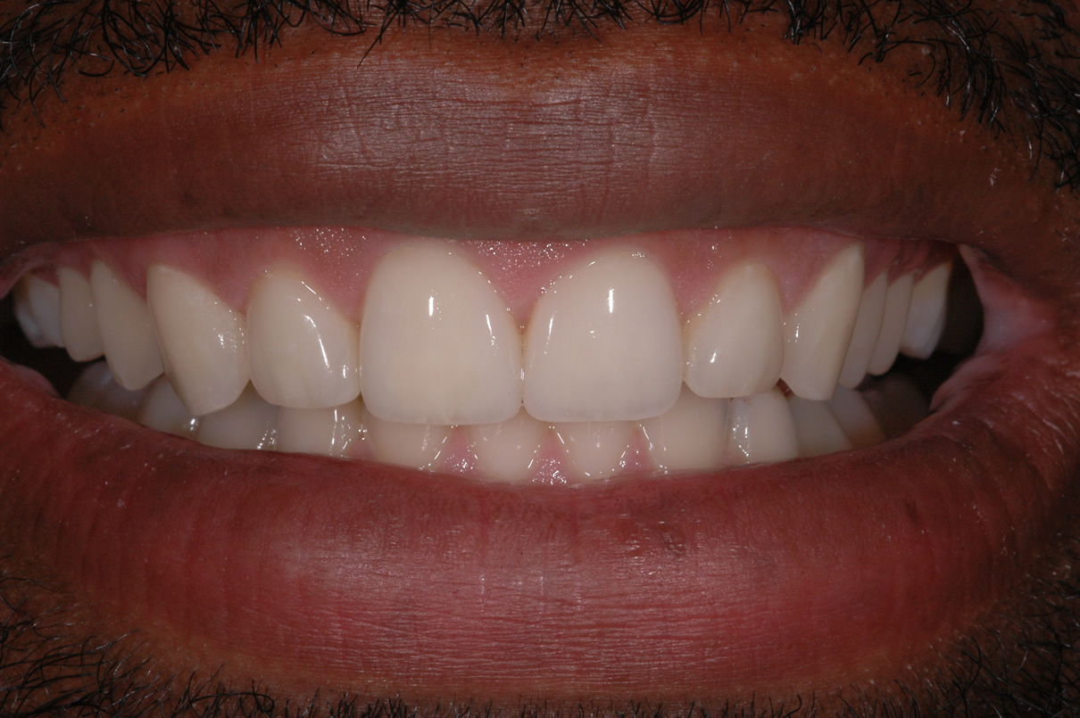 Veneers Case #1 - After