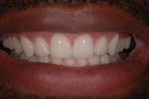 Veneers Case #1 - Charlotte, NC