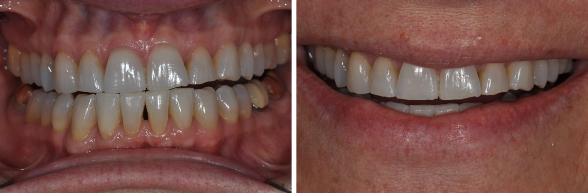 Veneers Case #2 - Before