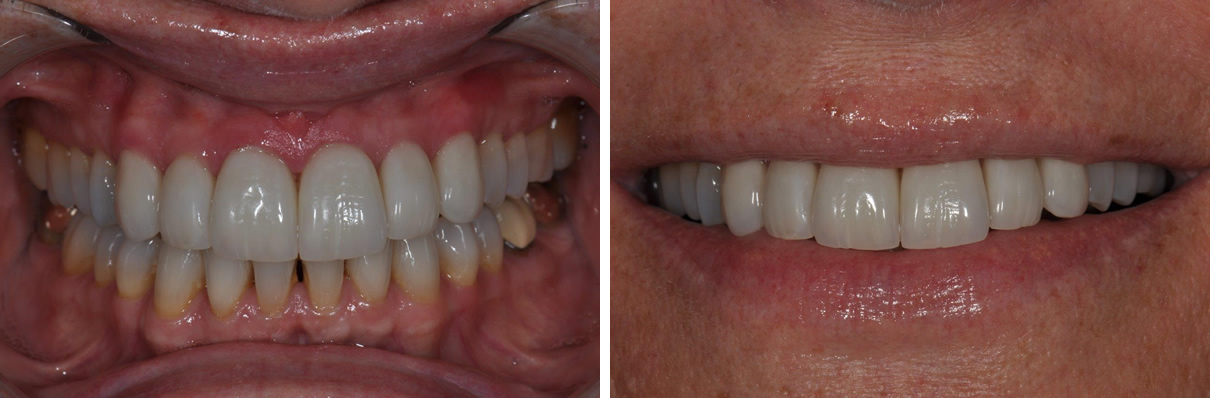 Veneers Case #2 - After