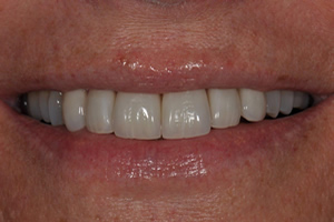 Veneers Case #2 - Charlotte, NC