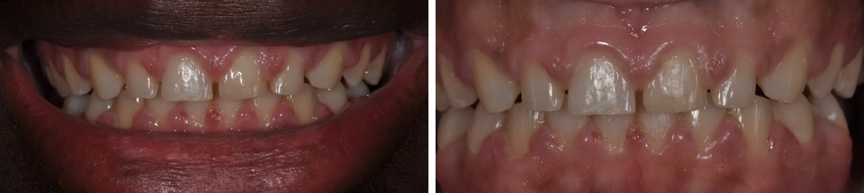 Veneers Case #3 - Before