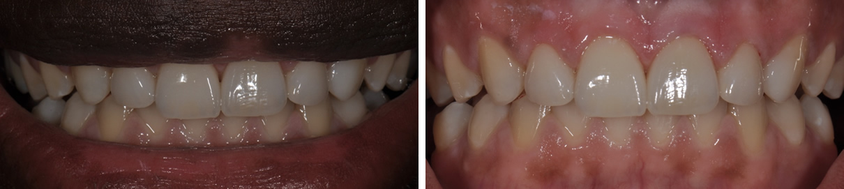 Veneers Case #3 - After