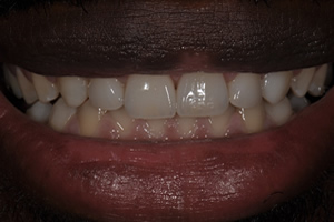 Veneers Case #3 - Charlotte, NC