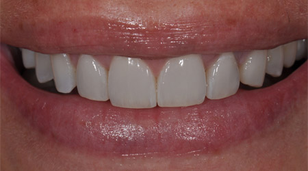 Restorative Dentistry in Charlotte, NC